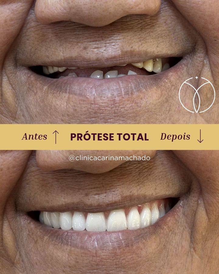 Antes e depois: Prótese total