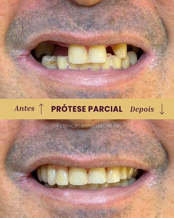 Antes e depois: Prótese parcial