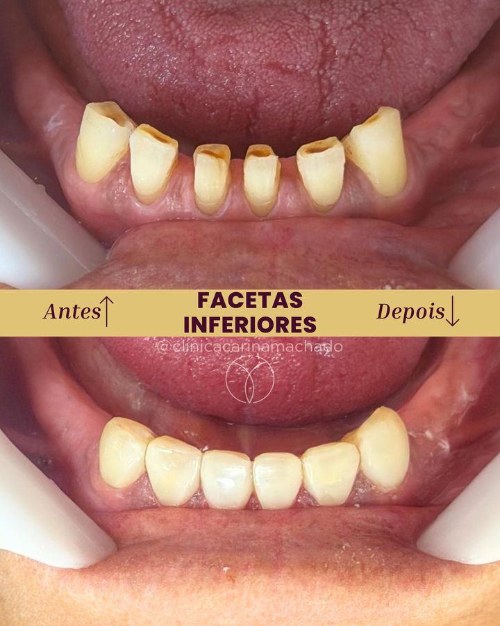 Antes e depois: Facetas inferiores