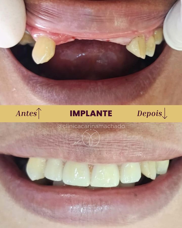 Antes e depois: Implante