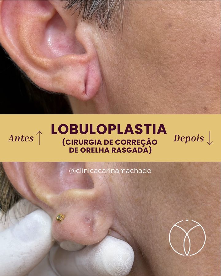 Antes e depois: Lobuloplastia