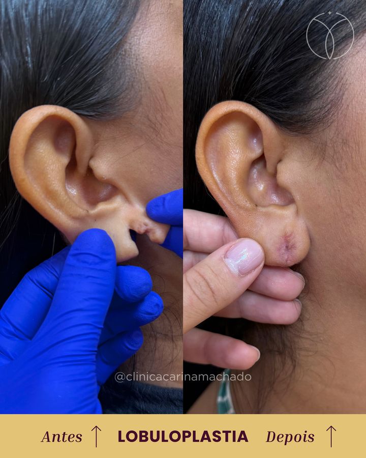 Antes e depois: Lobuloplastia
