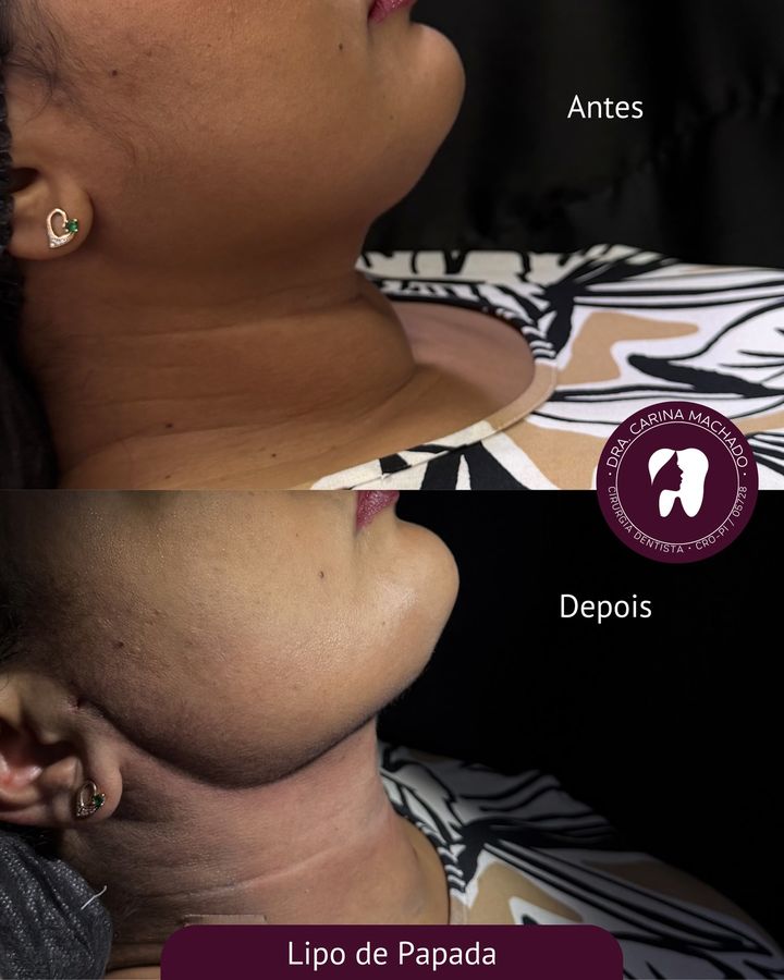 Antes e depois: Lipo de papada