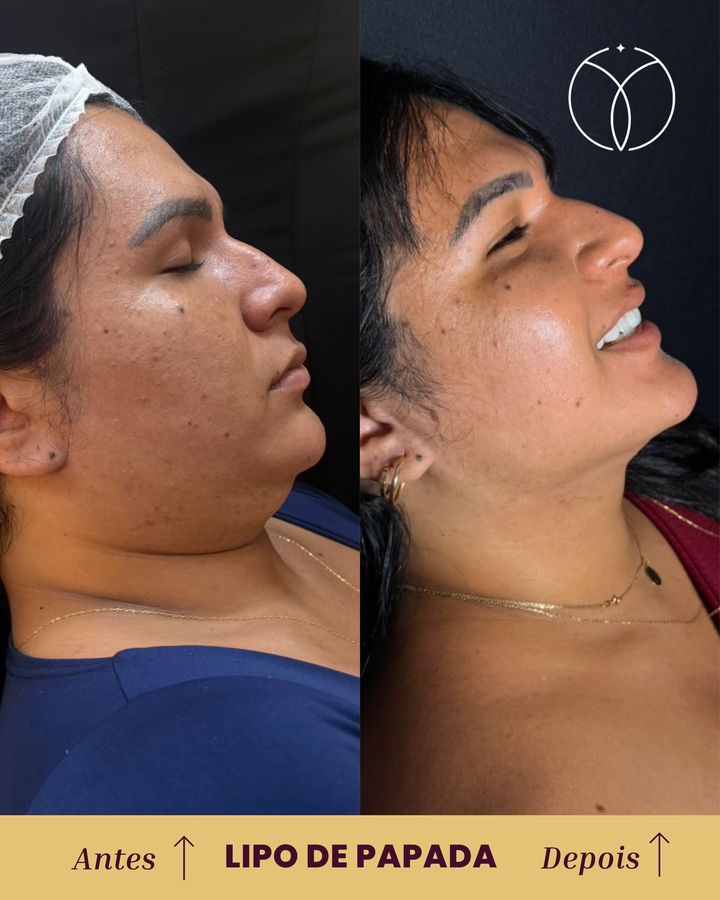 Antes e depois: Lipo de papada