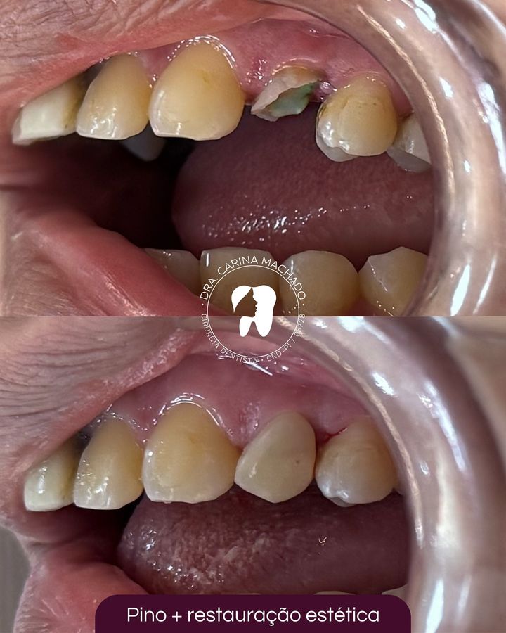 Antes e depois: Pino e restauração estética