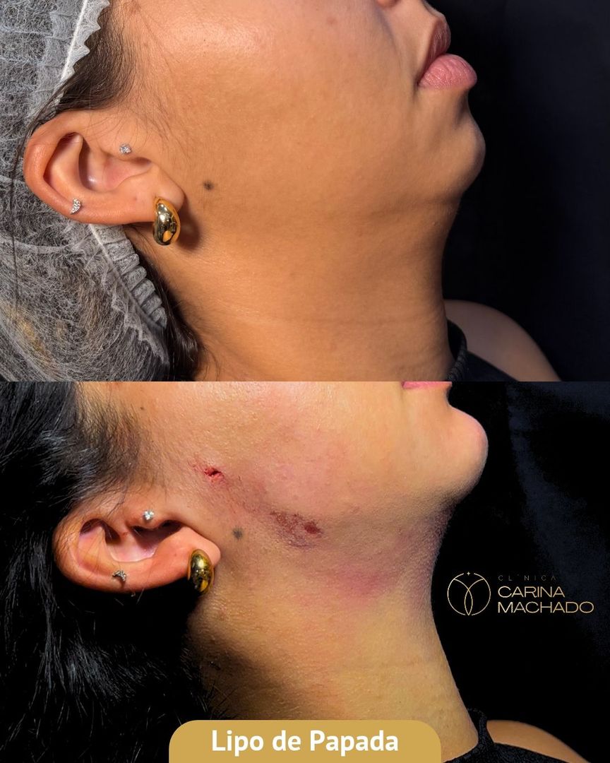 Antes e depois de lipo de papada