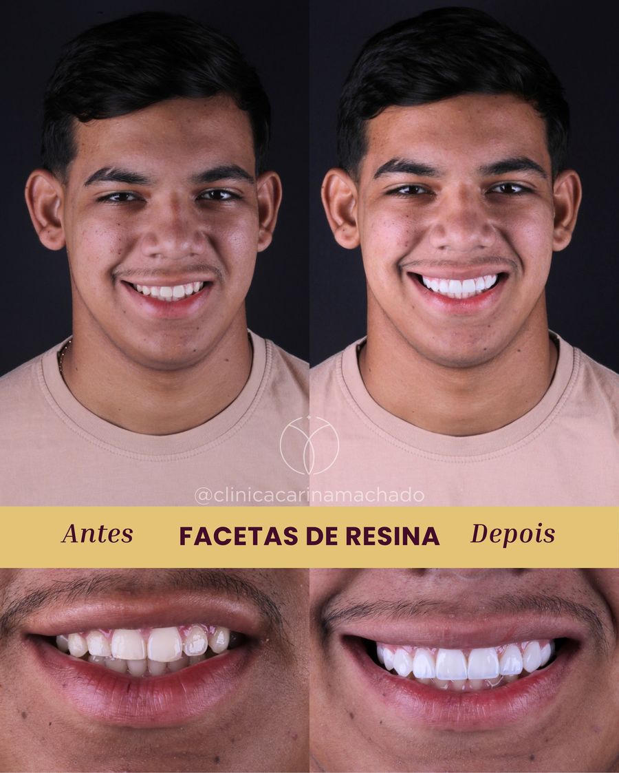 Antes e depois de facetas de resina em paciente da clínica