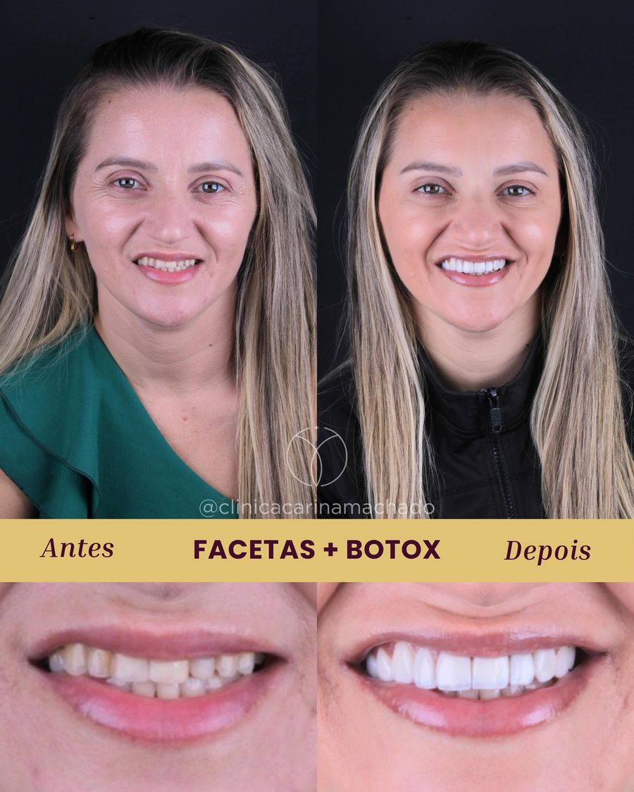 Antes e depois de facetas com botox